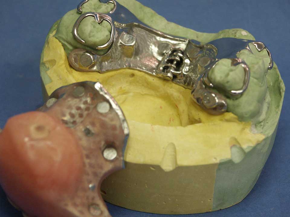Hinged 2 piece obturator with magnets + solid bulb for scleroderma patient with palatal defect