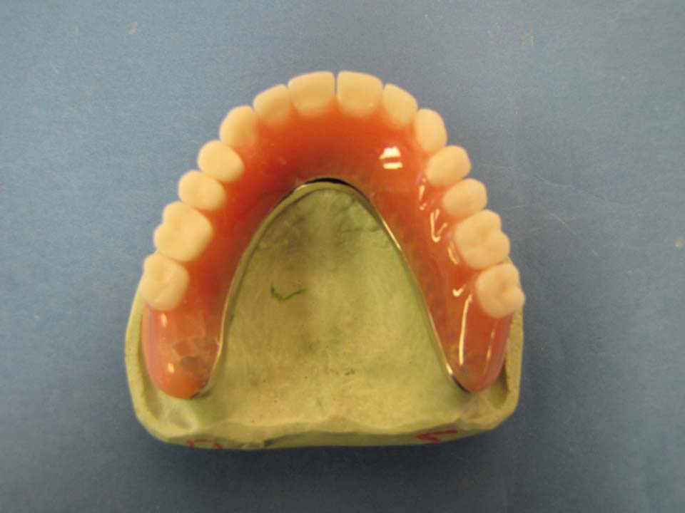 Denture over milled bar with Bredent attachments