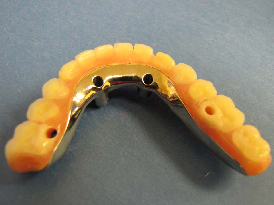 Implant Bars Zedan Dental Lab