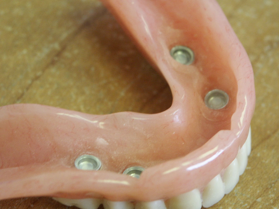 Lower denture with locator attachments