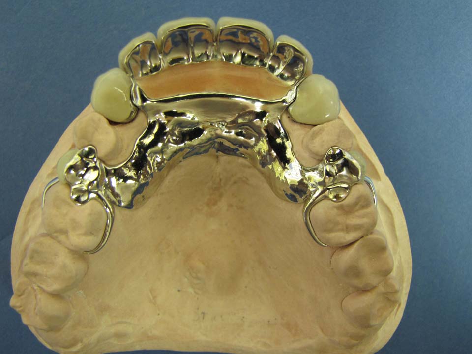 URPD with metal occlusials and facings