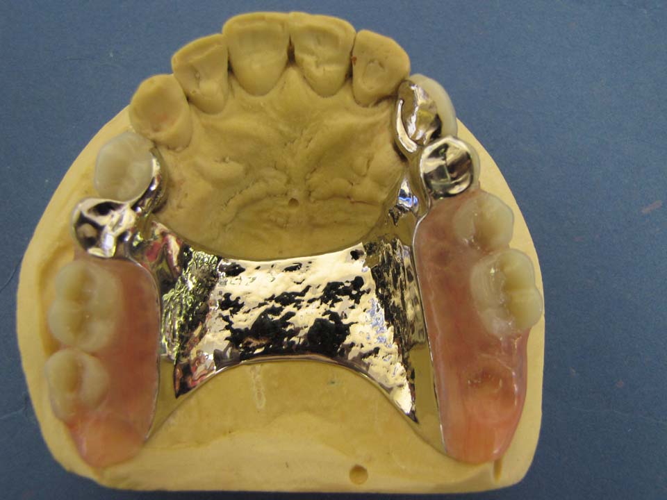 URPD with metal occlusials and Bredent attachment